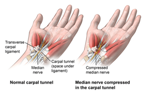 Pourquoi des gants mal ajustés peuvent provoquer des troubles musculosquelettiques (TMS) et comment les prévenir!